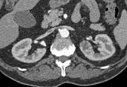 Subtle 2cm Left Renal Cell Carcinoma (RCC) With Multiple Phases and Images to Show Pitfalls of Lesion Detection - CTisus CT Scan