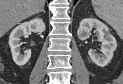 Subtle 2cm Left Renal Cell Carcinoma (RCC) With Multiple Phases and Images to Show Pitfalls of Lesion Detection - CTisus CT Scan