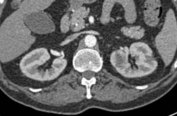 Subtle 2cm Left Renal Cell Carcinoma (RCC) With Multiple Phases and Images to Show Pitfalls of Lesion Detection - CTisus CT Scan