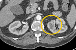 Subtle 2cm Left Renal Cell Carcinoma (RCC) With Multiple Phases and Images to Show Pitfalls of Lesion Detection - CTisus CT Scan