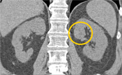 Subtle 2cm Left Renal Cell Carcinoma (RCC) With Multiple Phases and Images to Show Pitfalls of Lesion Detection - CTisus CT Scan