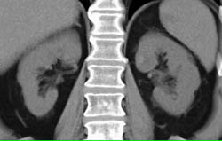 Subtle 2cm Left Renal Cell Carcinoma (RCC) With Multiple Phases and Images to Show Pitfalls of Lesion Detection - CTisus CT Scan