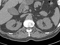 Subtle 2cm Left Renal Cell Carcinoma (RCC) With Multiple Phases and Images to Show Pitfalls of Lesion Detection - CTisus CT Scan