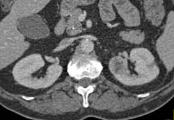 Subtle 2cm Left Renal Cell Carcinoma (RCC) With Multiple Phases and Images to Show Pitfalls of Lesion Detection - CTisus CT Scan