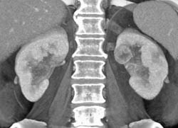 Subtle 2cm Left Renal Cell Carcinoma (RCC) With Multiple Phases and Images to Show Pitfalls of Lesion Detection - CTisus CT Scan