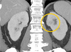 Subtle 2cm Left Renal Cell Carcinoma (RCC) With Multiple Phases and Images to Show Pitfalls of Lesion Detection - CTisus CT Scan