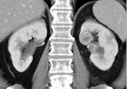 Subtle 2cm Left Renal Cell Carcinoma (RCC) With Multiple Phases and Images to Show Pitfalls of Lesion Detection - CTisus CT Scan