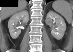 Subtle 2cm Left Renal Cell Carcinoma (RCC) With Multiple Phases and Images to Show Pitfalls of Lesion Detection - CTisus CT Scan