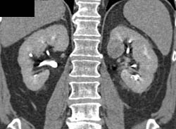 Subtle 2cm Left Renal Cell Carcinoma (RCC) With Multiple Phases and Images to Show Pitfalls of Lesion Detection - CTisus CT Scan