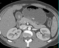 Acute Pyelonephritis - CTisus CT Scan