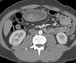 Acute Pyelonephritis - CTisus CT Scan