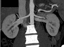 Acute Pyelonephritis - CTisus CT Scan