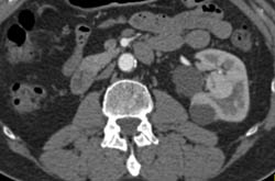 Renal Cysts With Septations - CTisus CT Scan