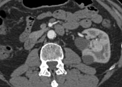 Renal Cell Carcinoma Near A Cyst - CTisus CT Scan