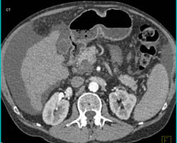 Right Renal Artery Aneurysm - CTisus CT Scan