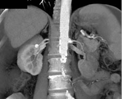 Right Renal Artery Aneurysm - CTisus CT Scan