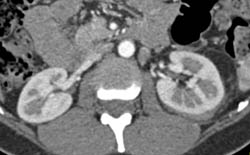 Subtle Renal Laceration With Bleed - CTisus CT Scan