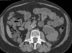 Reanastomosis of Right Kidney Into Iliac Artery With CTA - CTisus CT Scan