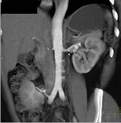 Renal Artery Aneurysm - CTisus CT Scan