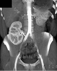 Reimplanted Right Ra - CTisus CT Scan