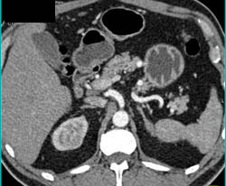 Subtle Right Renal Cell Carcinoma on Arterial Phase Images - CTisus CT Scan