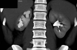 Blunted Calyces Right Kidney - CTisus CT Scan