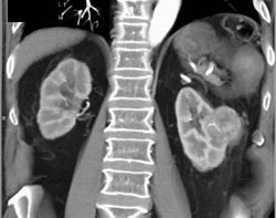 Left Clear Cell Renal Cell Carcinoma - CTisus CT Scan