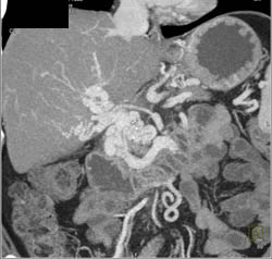 Cavernous Transformation of the Portal Vein (CTPV) With Collaterals Including to Left Kidney - CTisus CT Scan