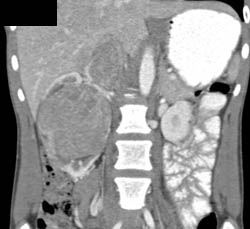Renal Cell Carcinoma Invades the Inferior Vena Cava (IVC) - CTisus CT Scan