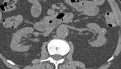Partially Calcified Benign Left Cyst - CTisus CT Scan