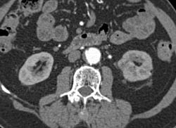 Subtle Carcinoma Lower Pole Left Kidney - CTisus CT Scan