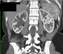 Right Hydronephrosis Due to Ureteropelvic Junction (UPJ) - CTisus CT Scan