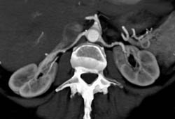 Fibromuscular Dysplasia (FMD) Left Renal Artery - CTisus CT Scan