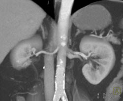 1cm Right Renal Artery Aneurysm - CTisus CT Scan