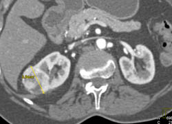 Vascular Renal Cell Carcinoma - CTisus CT Scan