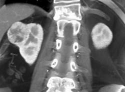 Vascular Renal Cell Carcinoma - CTisus CT Scan