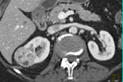 Vascular Renal Cell Carcinoma - CTisus CT Scan