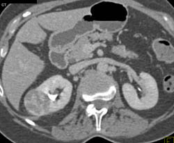 Vascular Renal Cell Carcinoma - CTisus CT Scan