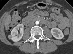 High Density Renal Cyst - CTisus CT Scan