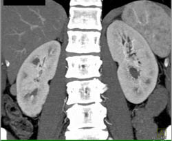 High Density Renal Cyst - CTisus CT Scan