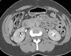 High Density Renal Cyst - CTisus CT Scan