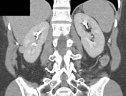 High Density Renal Cyst - CTisus CT Scan