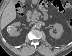 Calcified Rim of Renal Cyst - CTisus CT Scan