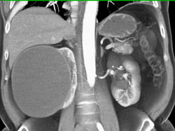 Large Right Renal Cyst and Angiomyolipoma (AML) - CTisus CT Scan