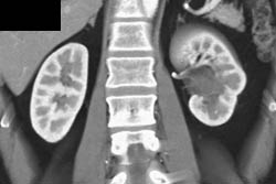 Subtle Left Transitional Cell Cancer (TCC) - CTisus CT Scan