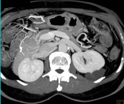 Perirenal Cyst - CTisus CT Scan