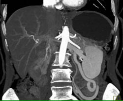 Huge Collaterals Near Left Kidney - CTisus CT Scan