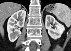 Left Vascular Renal Cell Carcinoma - CTisus CT Scan