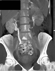 Dilated Right Ureter Due to Crossing Vessel - CTisus CT Scan