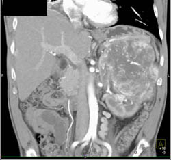 Hypervascular Renal Cell Carcinoma With Bone and Lung Metastases - CTisus CT Scan